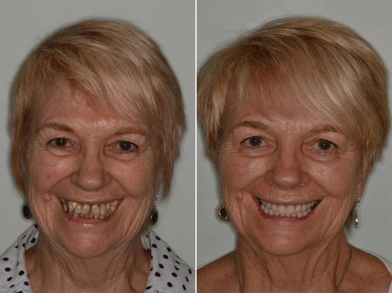 All-on-4 ® Dental Implants Before and After Photos in Miami, Florida, Patient 8598