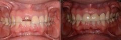 Dental Implants Before and After Photos in Miami, Florida, Patient 8618