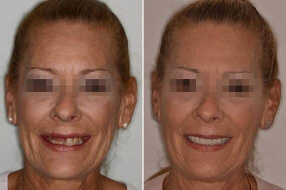 All-on-4 ® Dental Implants Before and After Photos in Miami, Florida, Patient 8701