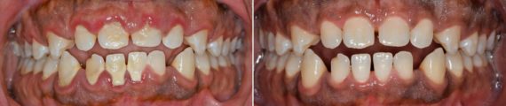 LANAP ® Before and After Photos in Miami, Florida, Patient 8873