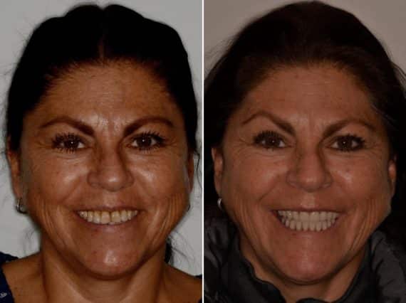 All-on-4 ® Dental Implants Before and After Photos in Miami, Florida, Patient 8863