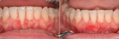 Gum Recession Before and After Photos in Miami, Florida, Patient 9223