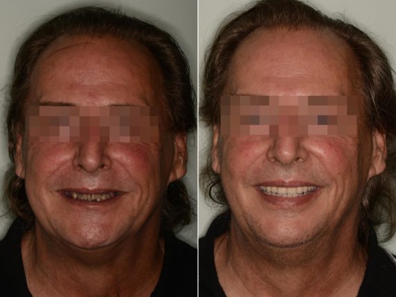 All-on-4 ® Dental Implants Before and After Photos in Miami, Florida, Patient 9191