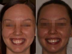 Gummy Smile Correction Before and After Photos in Miami, Florida, Patient 9228