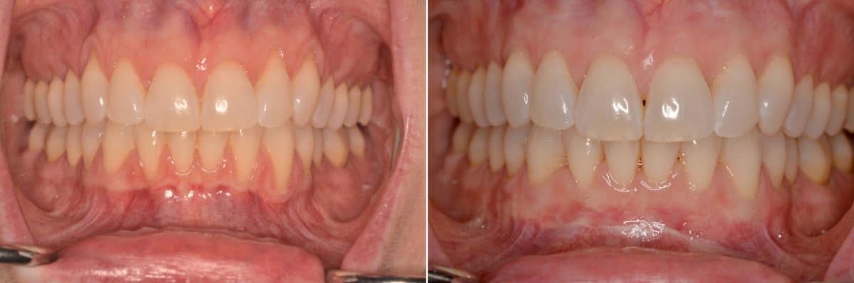 Gum Recession Before and After Photos in Miami, Florida, Patient 9232