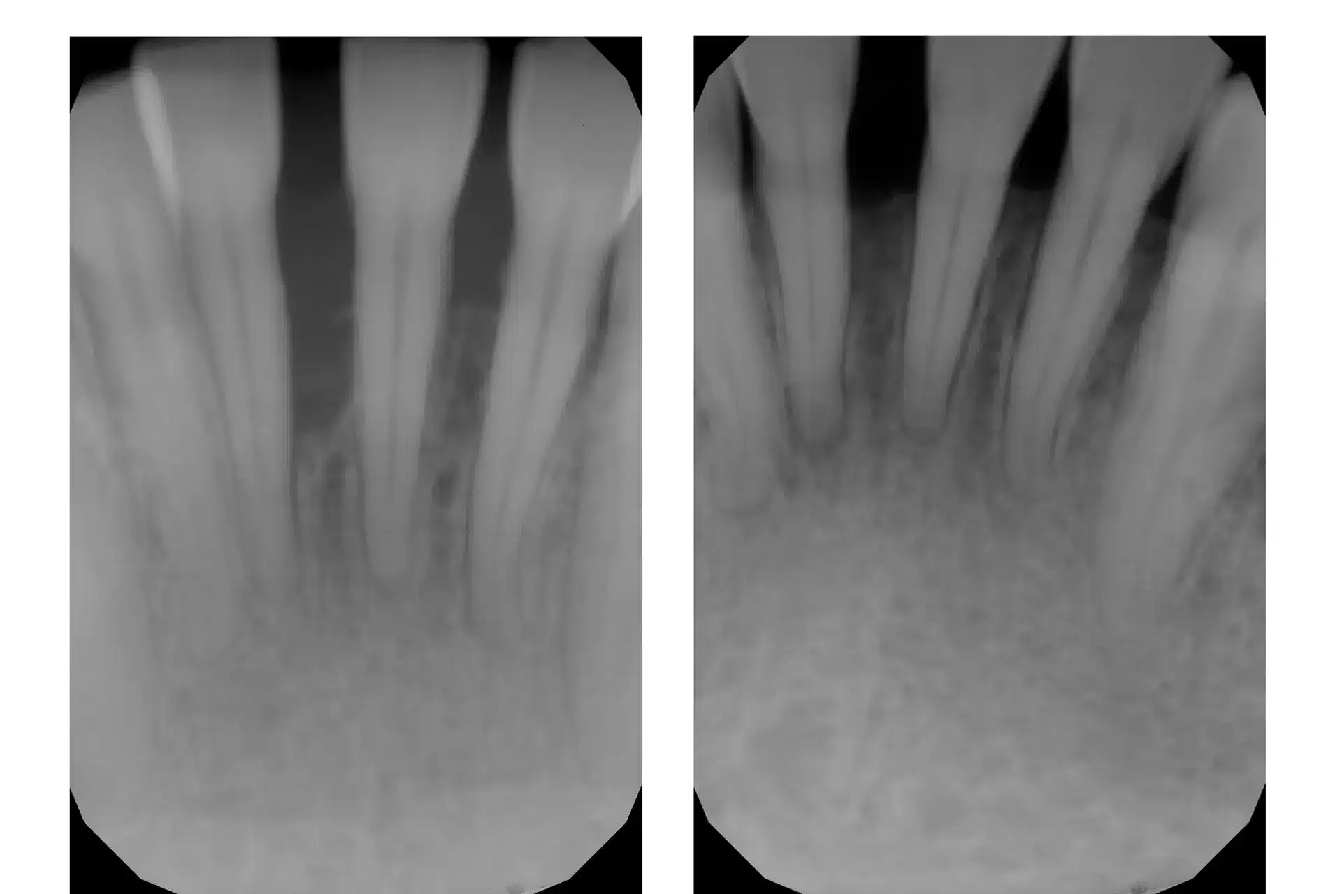 Lanap X-Ray