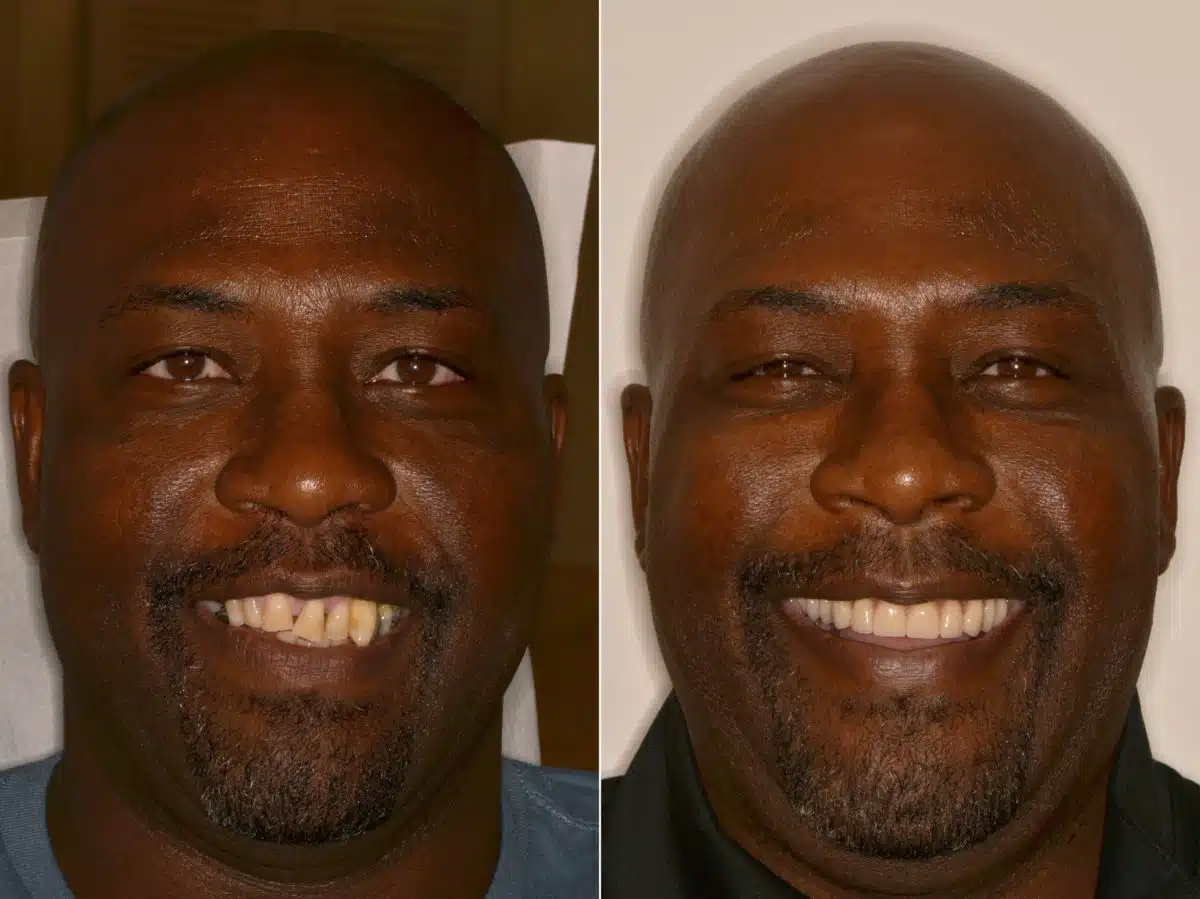 All-on-4 ® Dental Implants Before and After Photos in Miami, Florida, Patient 9671