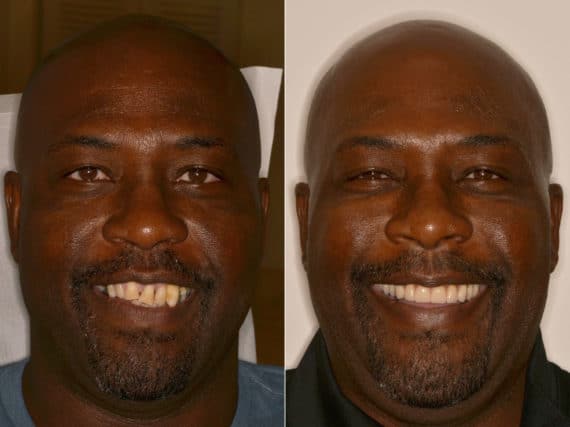 All-on-4 ® Dental Implants Before and After Photos in Miami, Florida, Patient 9671