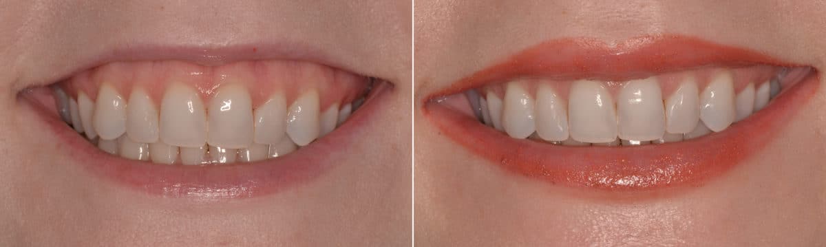 Gummy Smile Correction Before and After Photos in Miami, Florida, Patient 9713