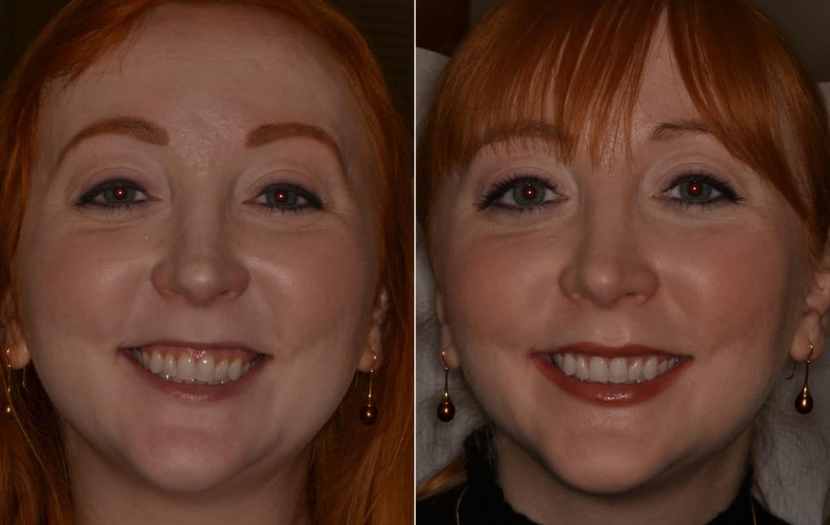 Gummy Smile Correction Before and After Photos in Miami, Florida, Patient 9713