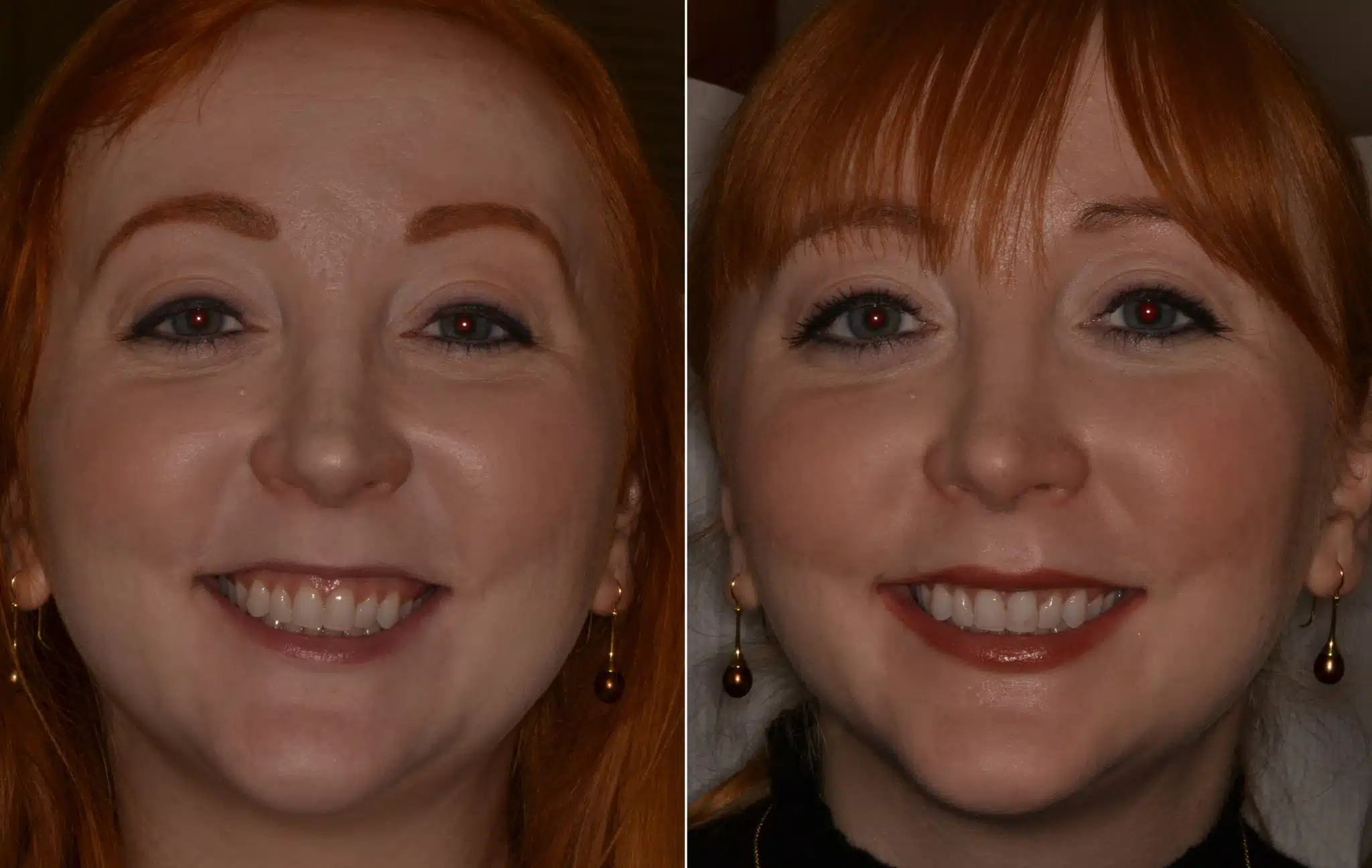 Gummy Smile Surgery | Miami | Lip Repositioning | Dr. Gallardo