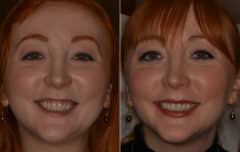 Gummy Smile Correction Before and After Photos in Miami, Florida, Patient 9713