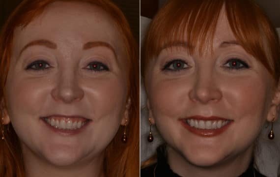 Gummy Smile Correction Before and After Photos in Miami, Florida, Patient 9713