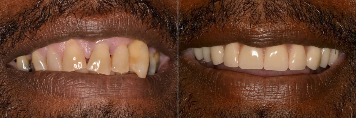 All-on-4 ® Dental Implants Before and After Photos in Miami, Florida, Patient 9671