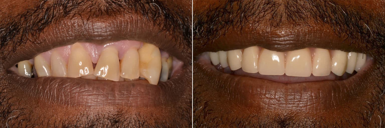Allon4 ® Dental Implants Photos Miami Patient 9671