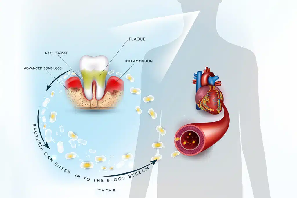 Can A Tooth Infection Cause Other Major Health Problems?