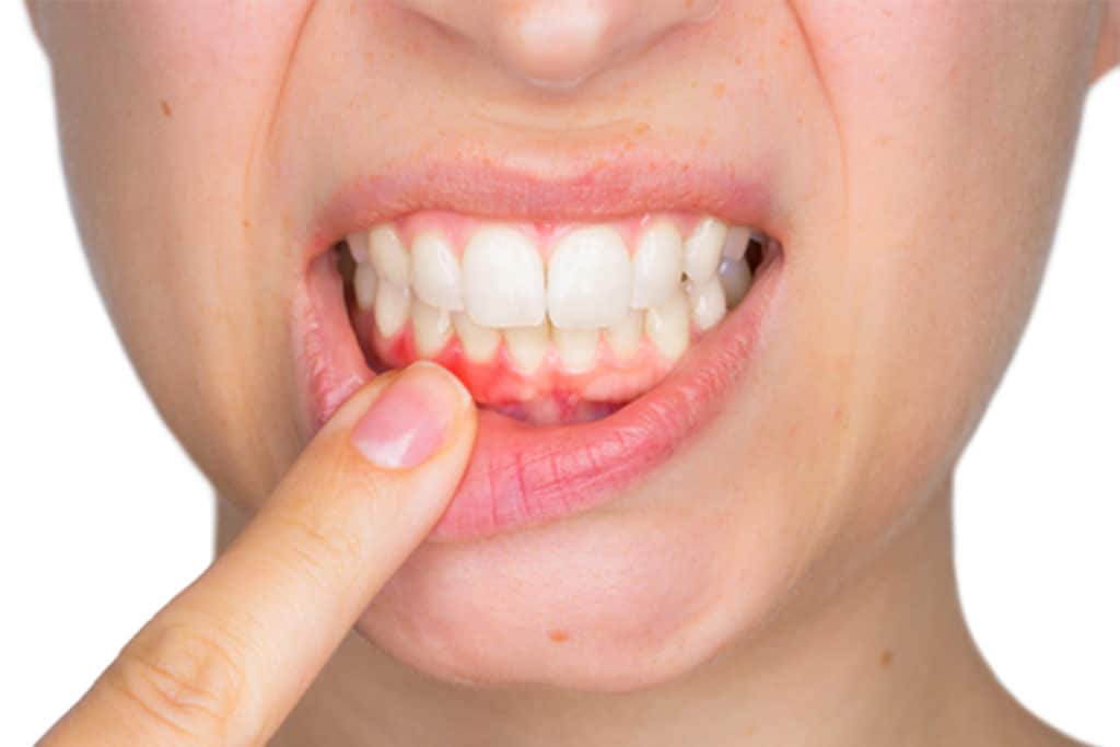 Receding Gums, Bleeding, and Other Red Flags of Gum Disease