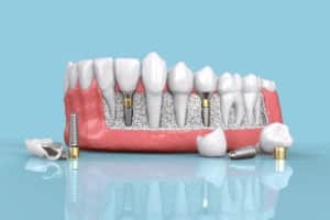 Do Dental Implants Have An Expiration Date?