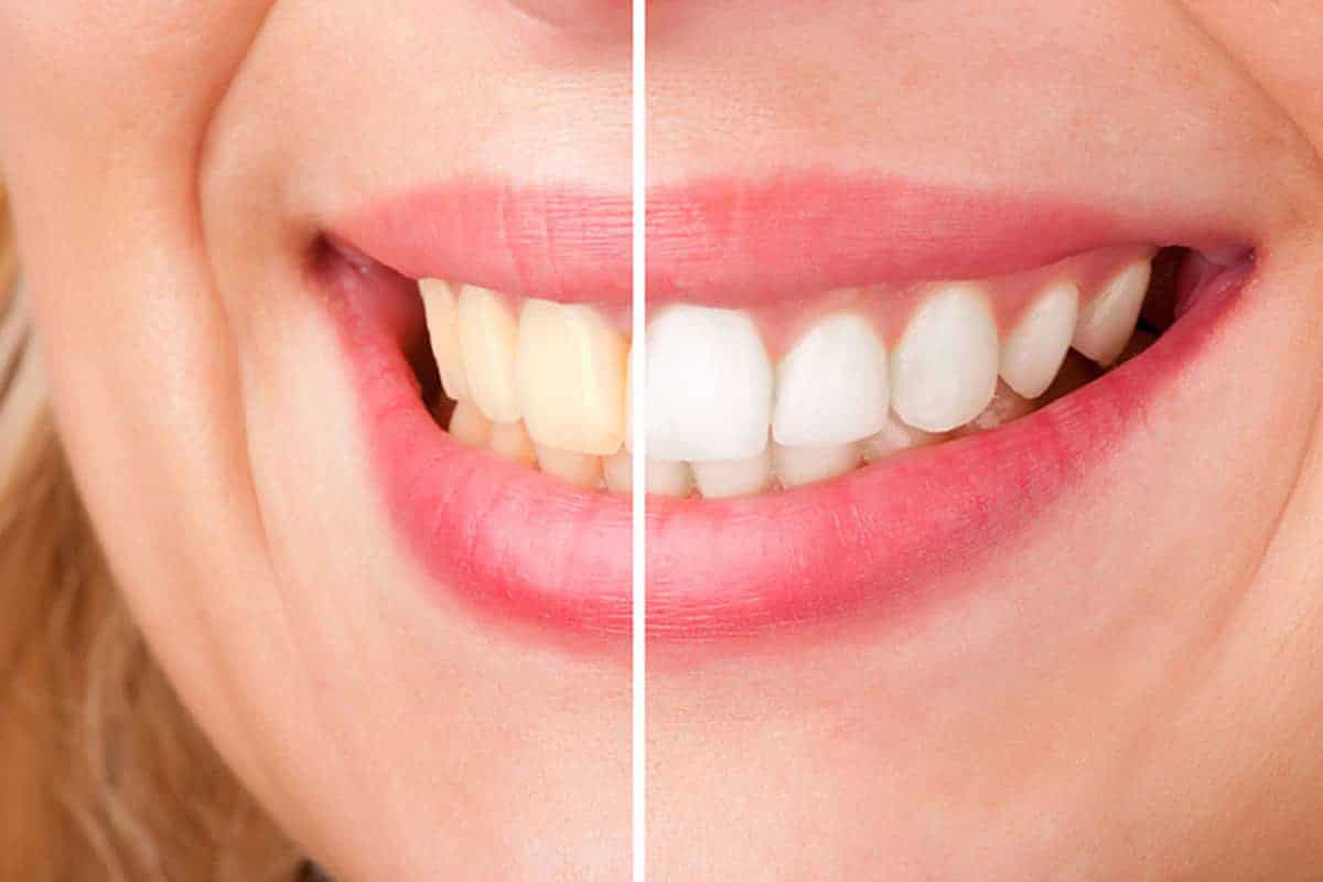 Teeth Cleaning Miami Fl Teeth Cleaning Miami Fl