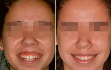 Gummy Smile Correction Before and After Photos in Miami, Florida, Patient 169