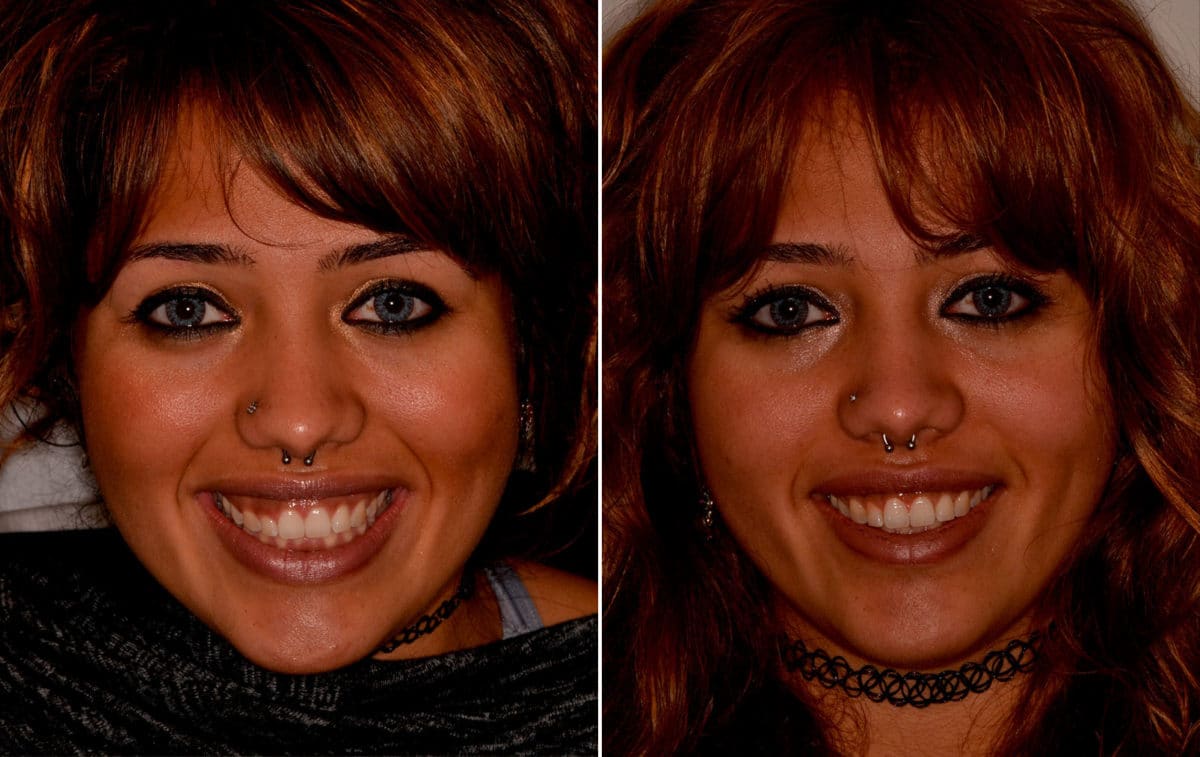 Gummy Smile Correction Before and After Photos in Miami, Florida, Patient 9162