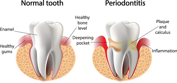 An excess of “bad” mouth bacteria can be pretty harmful, contributing to bad breath and increasing your risk of developing cavities