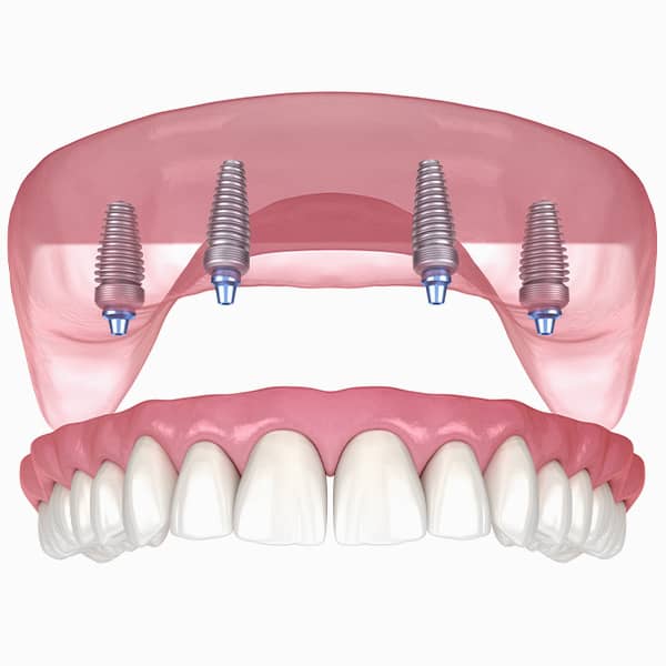 All-on-4® Implants are superior to dentures in almost every way.