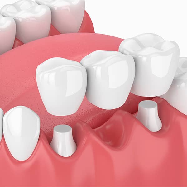 Your dental bridge can be closely matched to the color of the adjacent teeth, leading to a natural appearance