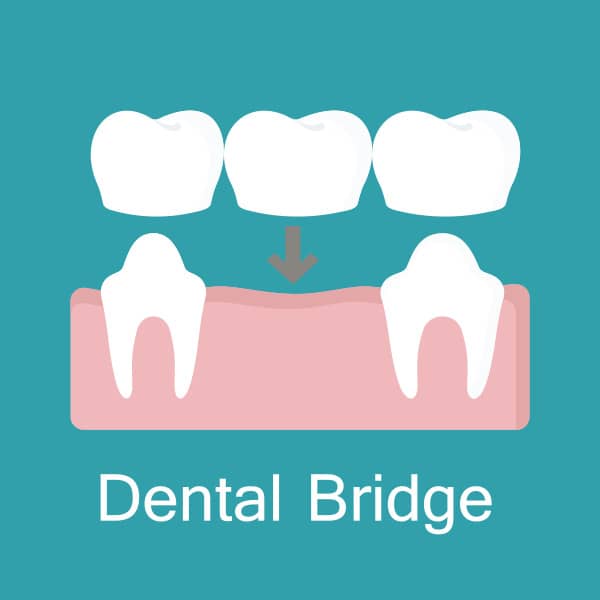 Dental bridges are created to bridge the gap left by one or more missing teeth. Dr. John Paul Gallardo | Miami, FL