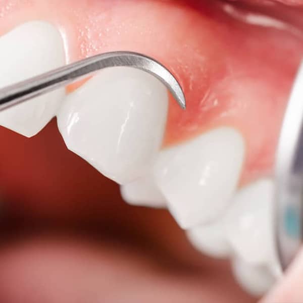 The visible portion of the tooth is referred to as the clinical crown.