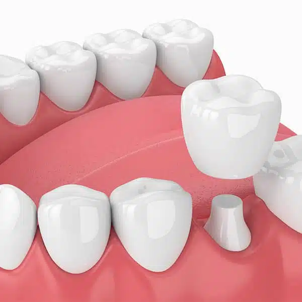 Dental crowns for implants can replace a missing tooth altogether by attaching to the metal screw that is fixed into the jawbone.