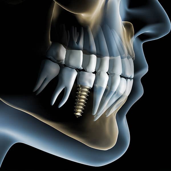 More than 95% of all dental implants provide positive results.