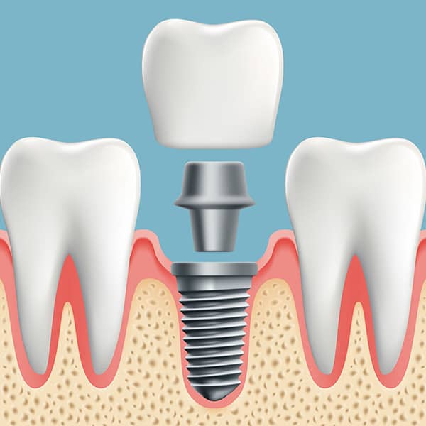 The dentist will determine how many anchors are required, and how many can be placed during a single appointment.