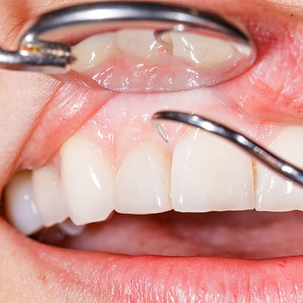 Gum disease is usually discovered during a routine checkup by a dental professional