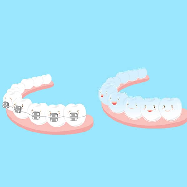 Braces vs. Invisible Aligners