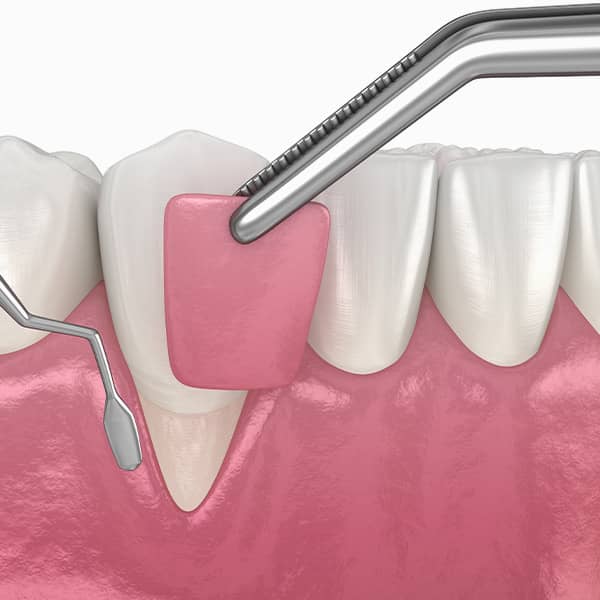 Gum grafting was once considered the 'go-to' procedure in the treatment of a receding gumline. Dr. John Paul Gallardo |  Miami, FL