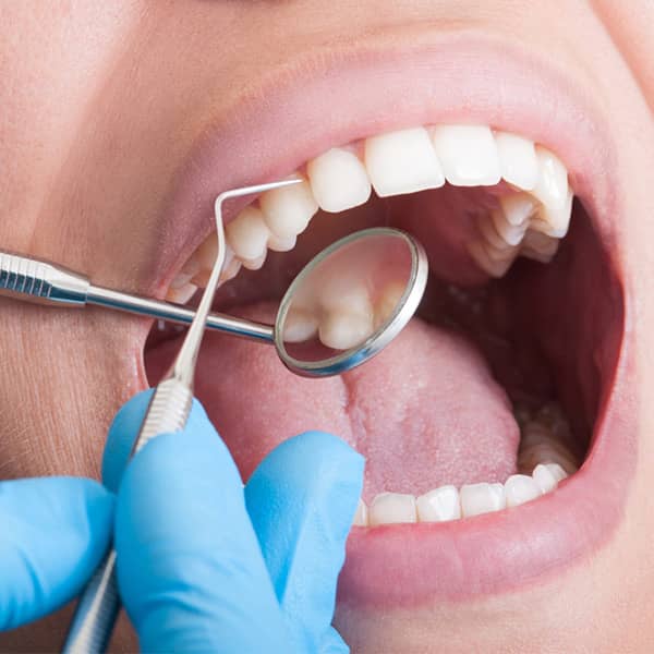 The deep cleaning process is performed as part of the periodontal prophylaxis treatment.