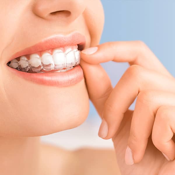 KöR is considered the most effective Teeth whitening procedure.