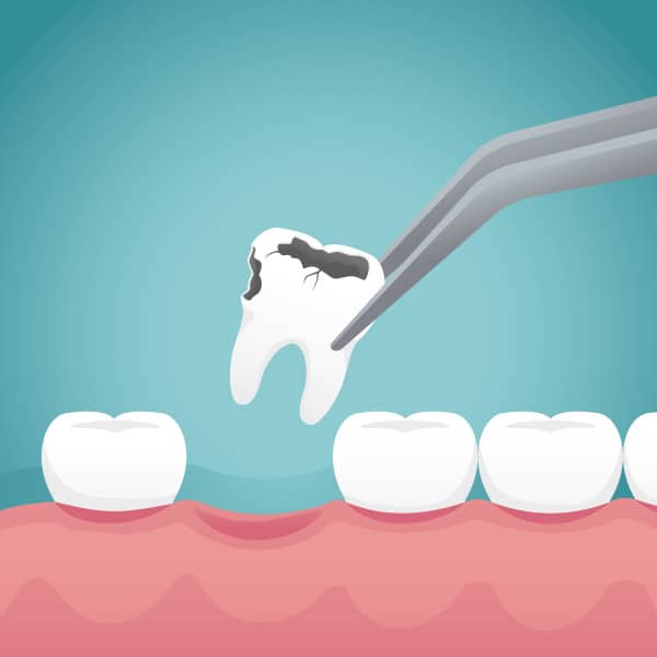 While dentists do their best to save a tooth that has been injured or has tooth decay, there are instances when extraction must be done as the best option for a patient's dental care.