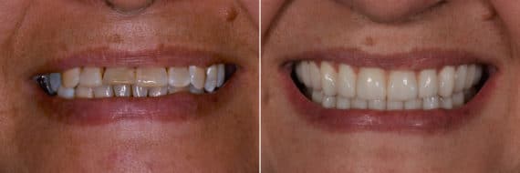 All-on-4 ® Dental Implants Before and After Photos in Miami, Florida, Patient 12621