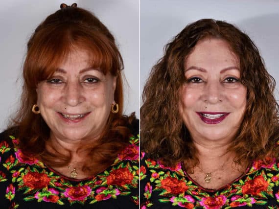 All-on-4 ® Dental Implants Before and After Photos in Miami, Florida, Patient 12634