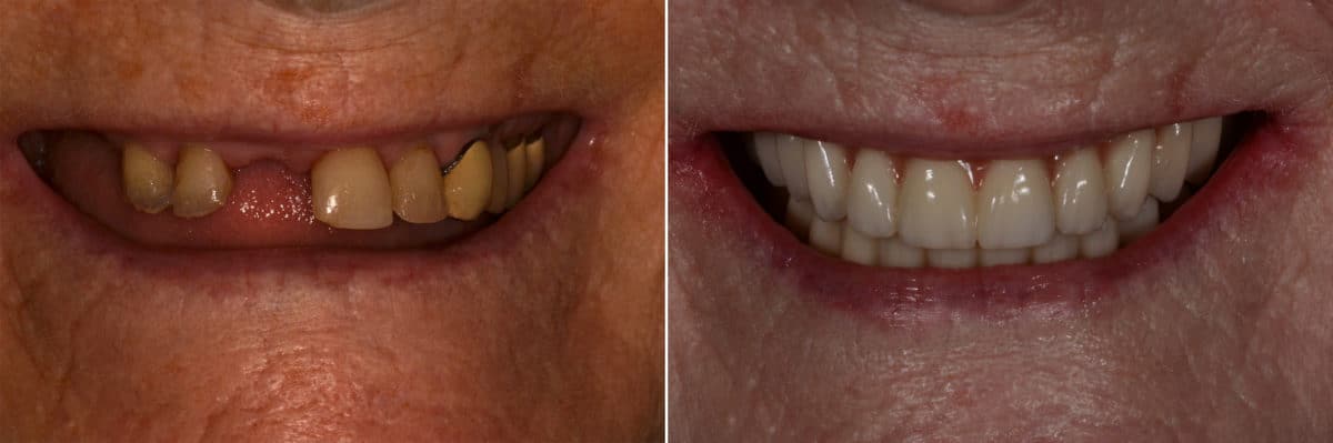 All-on-4 ® Dental Implants Before and After Photos in Miami, Florida, Patient 12638