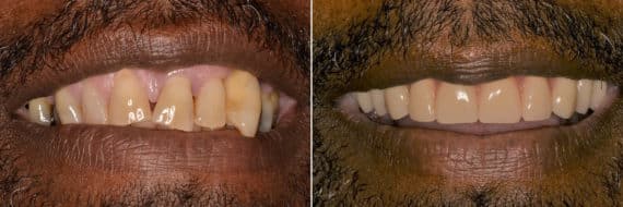 All-on-4 ® Dental Implants Before and After Photos in Miami, Florida, Patient 12640