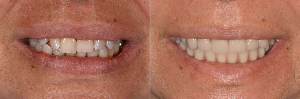 All-on-4 ® Dental Implants Before and After Photos in Miami, Florida, Patient 12642