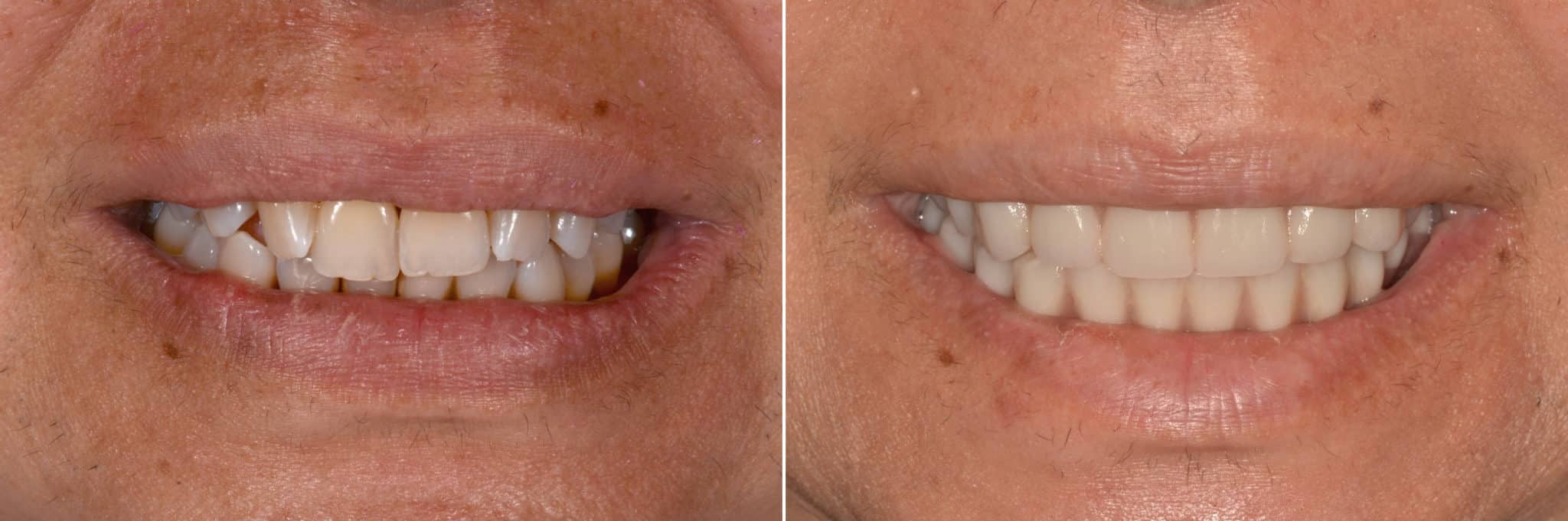 Allon4 ® Dental Implants Photos Miami Patient 12642