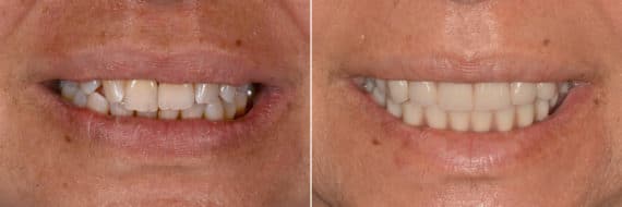 All-on-4 ® Dental Implants Before and After Photos in Miami, Florida, Patient 12642