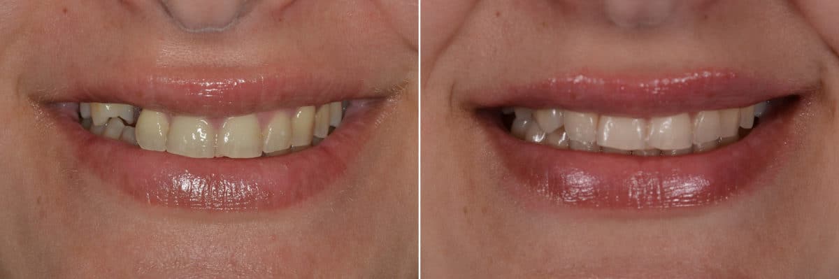 LANAP ® Before and After Photos in Miami, Florida, Patient 12646