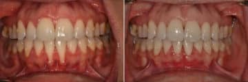 LANAP ® Before and After Photos in Miami, Florida, Patient 12648