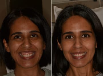 Gummy Smile Correction Before and After Photos in Miami, Florida, Patient 12699