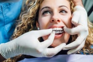 Periodontist with sterile gloves inserting Invisalign in a young patient